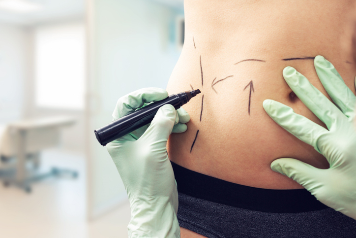 plastic surgeon marking womans body for surgery